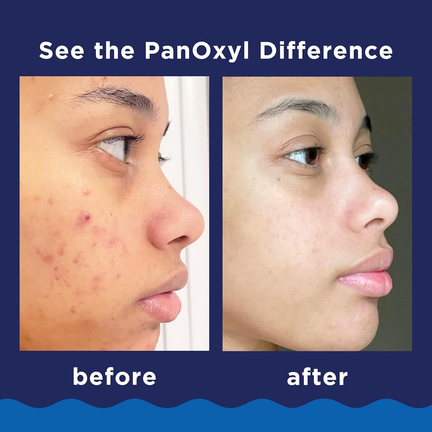 PanOxyl Acne Foaming Wash for face &amp; body Benzoyl Peroxide 10% Maximum Strength Antimicrobial, 3 oz. - Travel Size