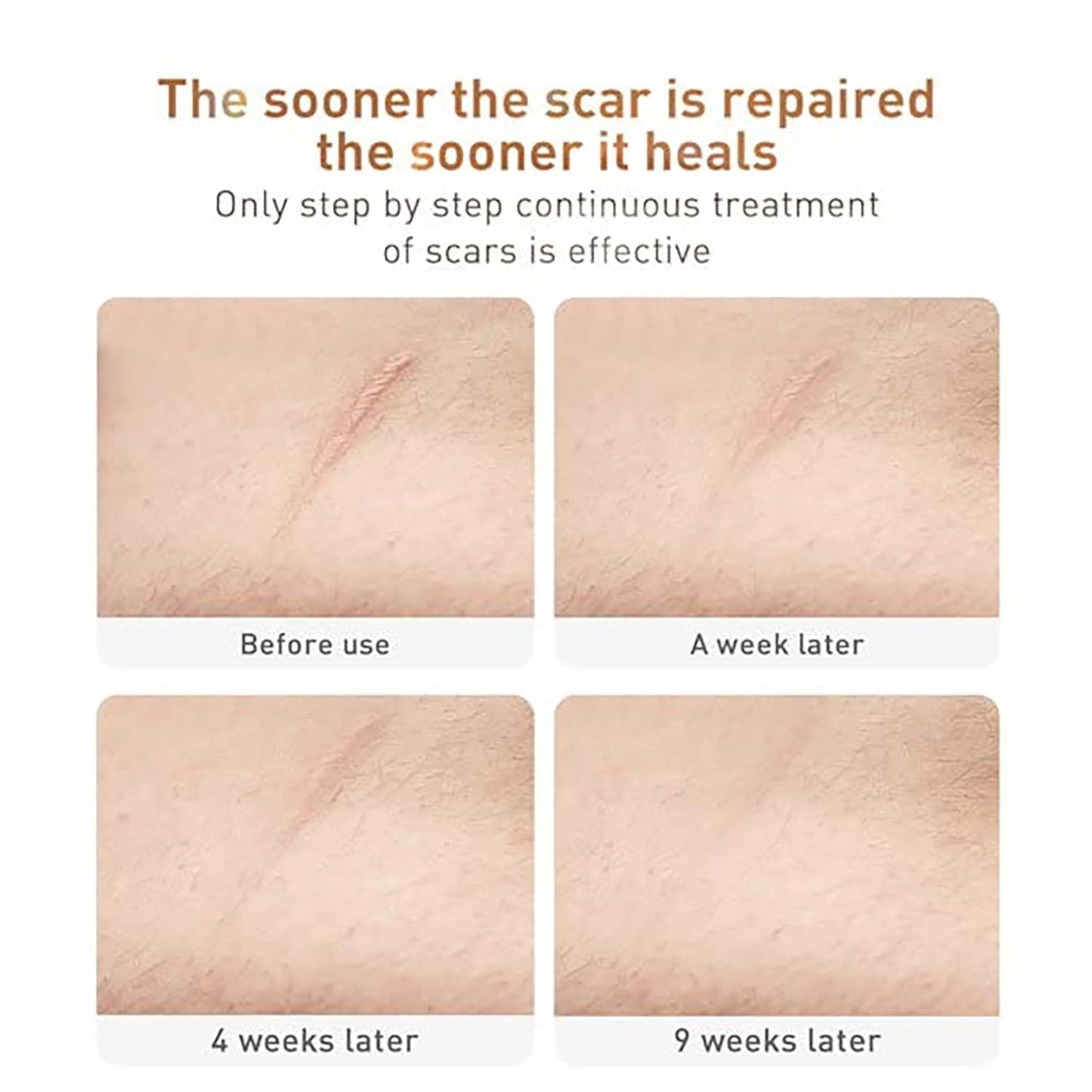 Acne Scar Removal Cream, Herbal Fade Scar Marks Burns Repair Cream, Stretch Marks Face Skin Cream Shrink Pores Gel..
