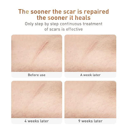 Acne Scar Removal Cream, Herbal Fade Scar Marks Burns Repair Cream, Stretch Marks Face Skin Cream Shrink Pores Gel..