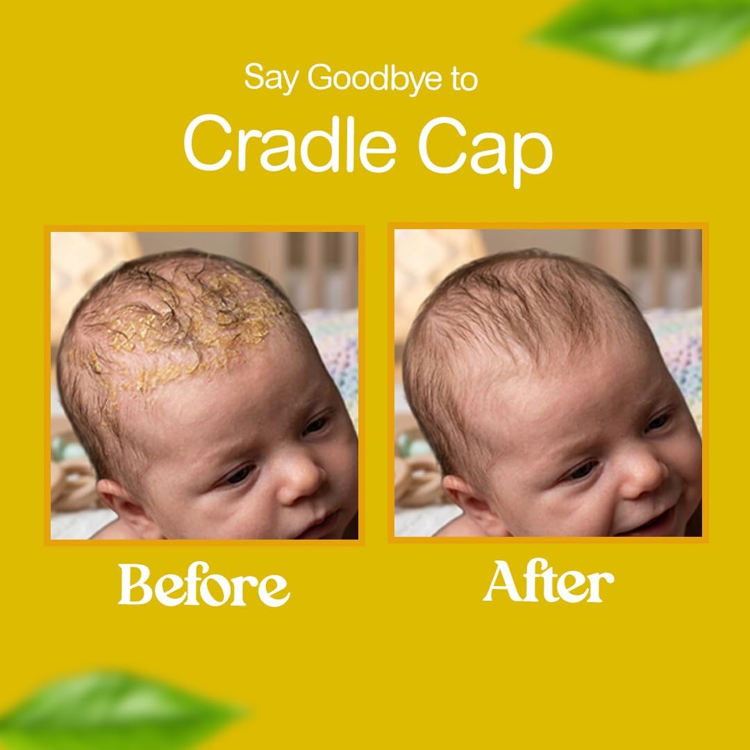 BELLA B Bee Gone Cradle Cap Baby Shampoo Treatment, 8 oz, Organic Natural Dry Scalp Shampoo..