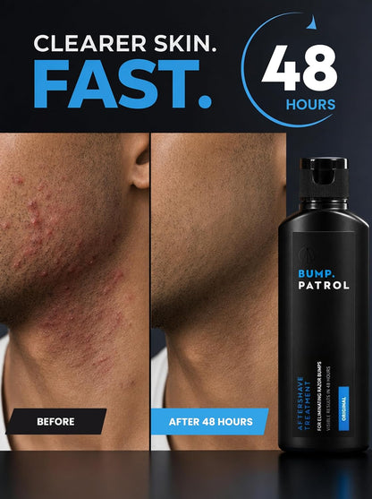 Bump Patrol Original Formula Aftershave Treatment Serum – Razor Bump Stopper and Ingrown Hair Treatment for Men and Women..