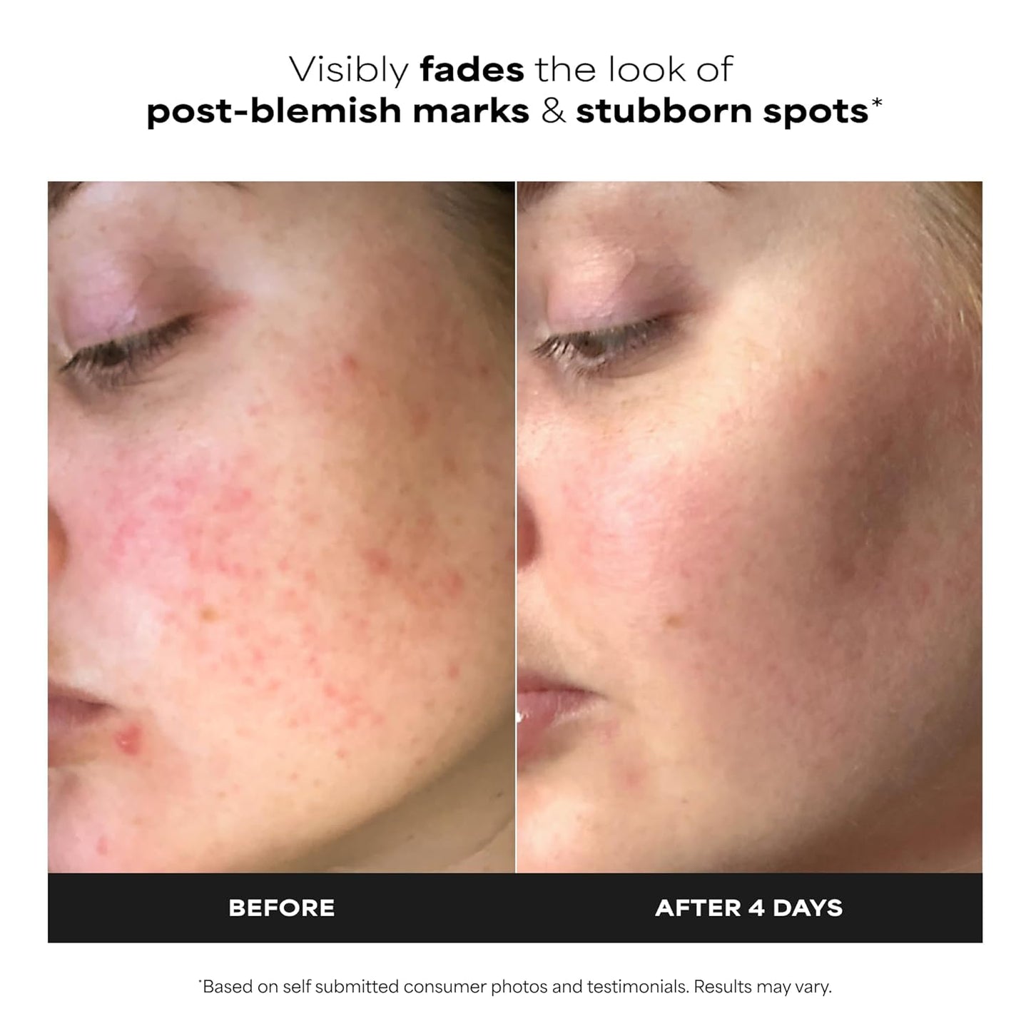 Paula's Choice BOOST 10% Azelaic Acid Booster Cream Gel Face Serum with Salicylic Acid..