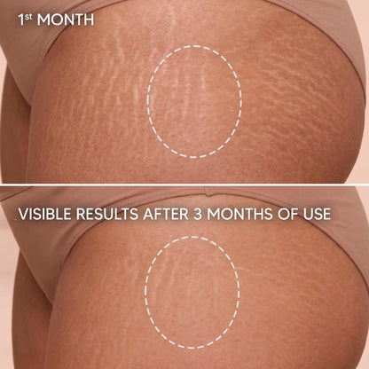 Cicatrissim Stretch Mark Cream for Red and White Striae - Softens Stretch Marks, Evens Skin Tone, and Firms Skin..
