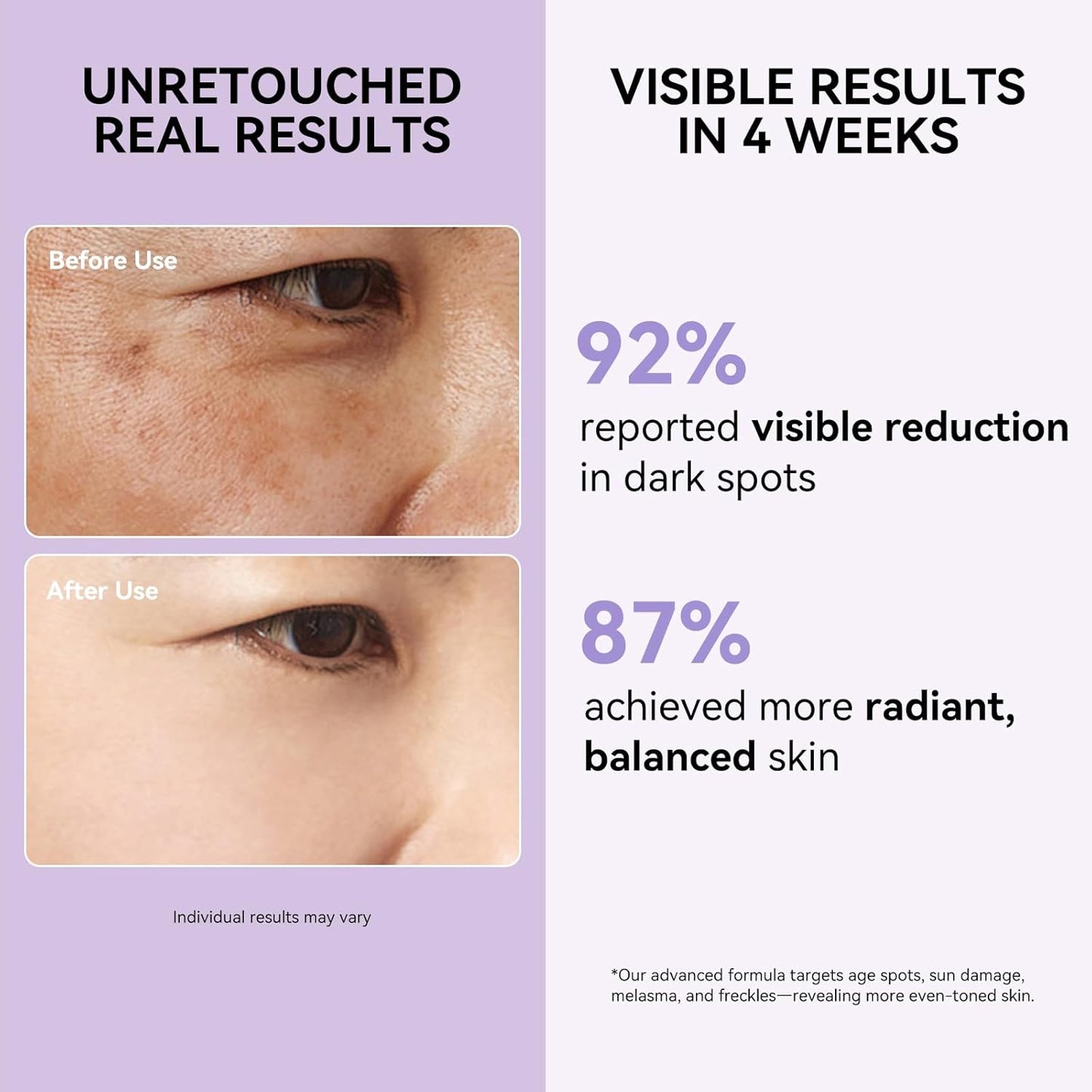 Dark Spot Remover for Face and Body - Dark Spot Corrector Serum for Sun Spots, Age Spots, Brown Spot, Freckles & Melasma