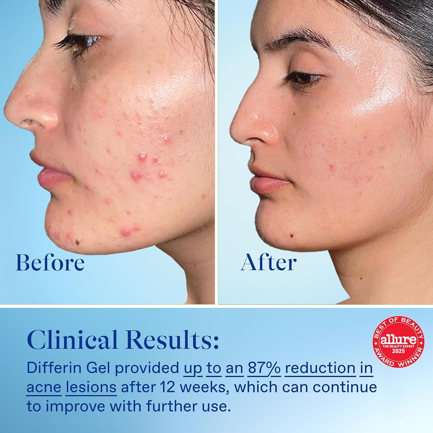 Differin Acne Treatment Gel, 60 Day Supply, Retinoid Treatment for Face with 0.1% Adapalene, Gentle Skin Care for Acne Prone Sensitive Skin..