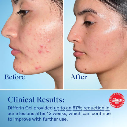 Differin Acne Treatment Gel, 60 Day Supply, Retinoid Treatment for Face with 0.1% Adapalene, Gentle Skin Care for Acne Prone Sensitive Skin..