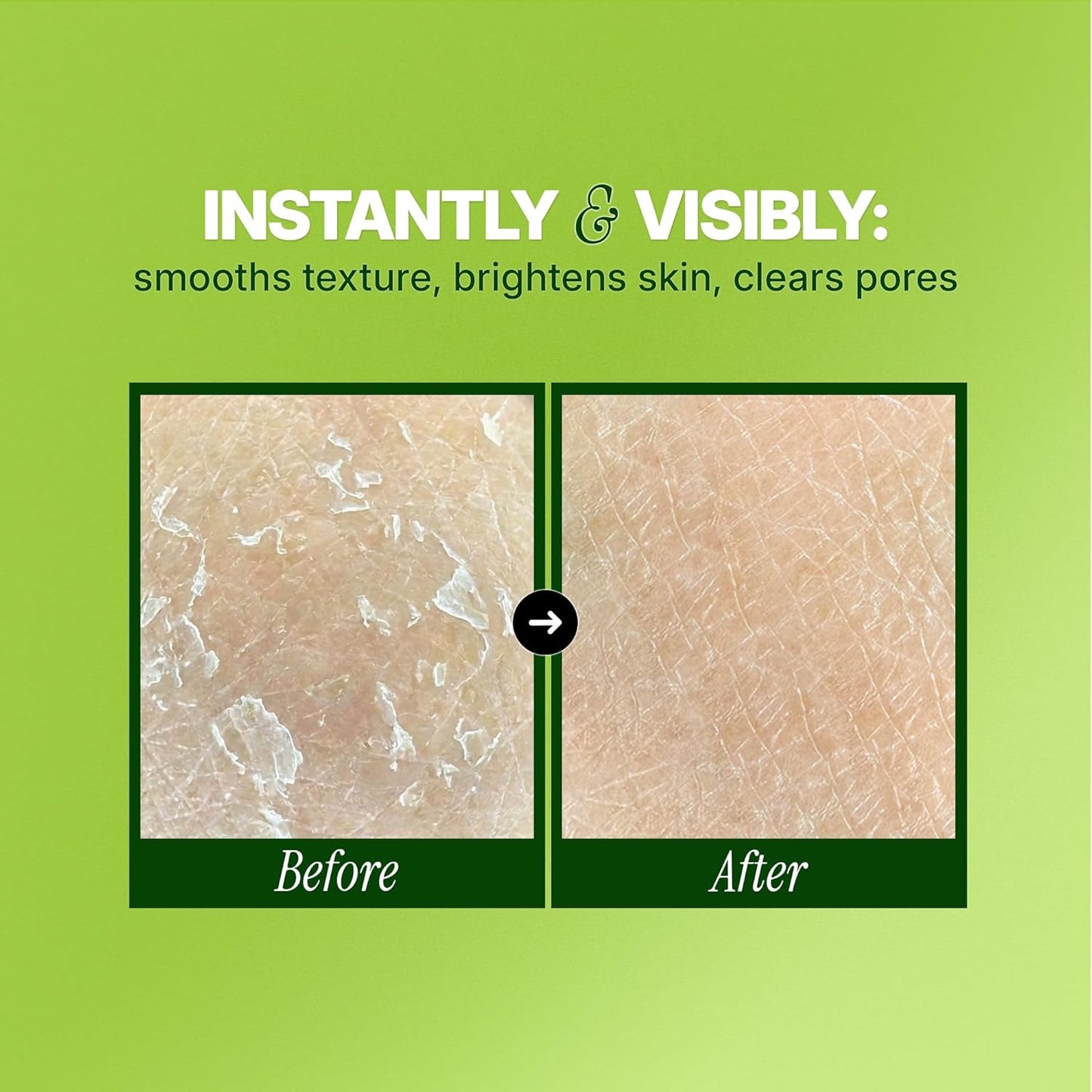 Ebanel Chemical Peel for Face, AHA BHA Exfoliator, Glycolic Acid Peel, Salicylic &amp; Lactic Acid Face Peeling Gel