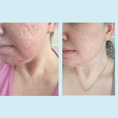 Glycolic Gel Peel - Enhanced with Retinol and Green Tea Extract (70% Strength)