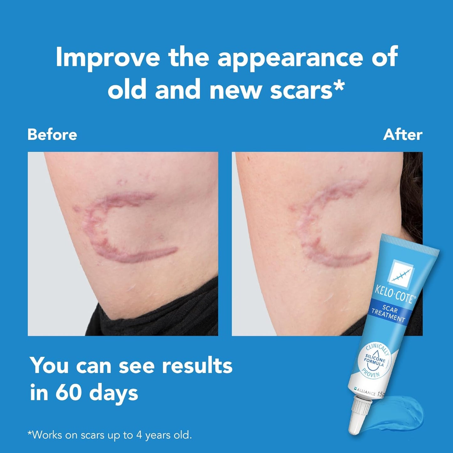 Kelo-Cote Gel for Scars 6g by Kelo-Cote | Size 6 g | Style - Silicone Scar Gel