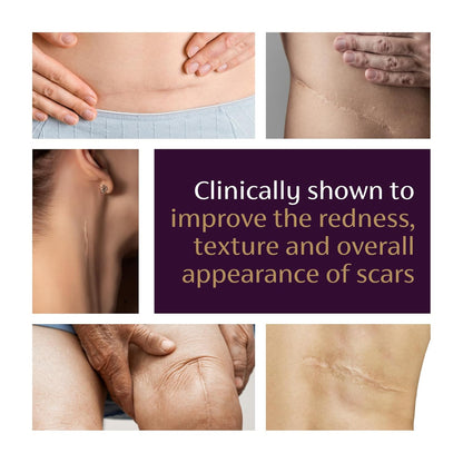 Mederma Advanced Scar Gel - Treats Old &amp; New Scars, Reduces Appearance of Scars from Acne..