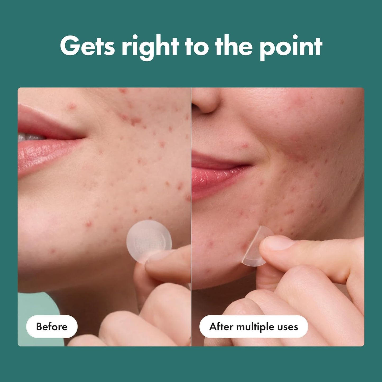 Mighty Patch Hero Cosmetics Micropoint Acne Pimple Patches, 8 Ct | For Early Stage Zits & Hidden Blemishes..