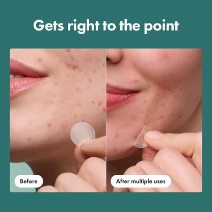 Mighty Patch Hero Cosmetics Micropoint Acne Pimple Patches, 8 Ct | For Early Stage Zits & Hidden Blemishes..