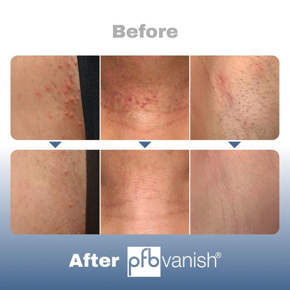 PFB Vanish Razor Bump Treatment (3.28 oz) After Shave Serum Smoothing Solution Ingrown Hair Treatment, Relieves & Softens Skin...