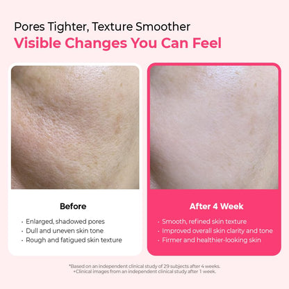 Dr.Melaxin Cyano Pink Spicule Serum with Vitamin B12, Liquid Microneedle Facial Treatment for Enlarged Pores..