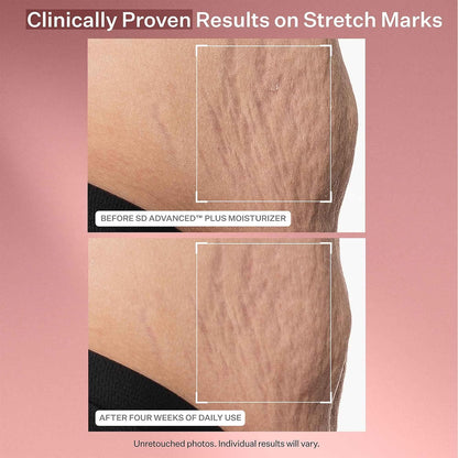 StriVectin SD Advanced Plus Intensive Moisturizer for Wrinkles and Stretchmarks