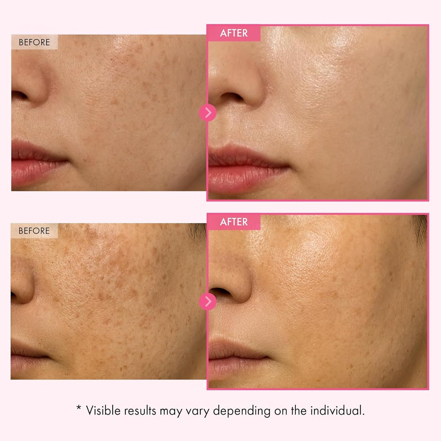 TOSOWOONG Arbutin 7% Glutathione Cream, 70,000ppm Arbutin + 5,001ppm Glutathione, Niacinamide, Dark Spots, Freckle, Blemishes..