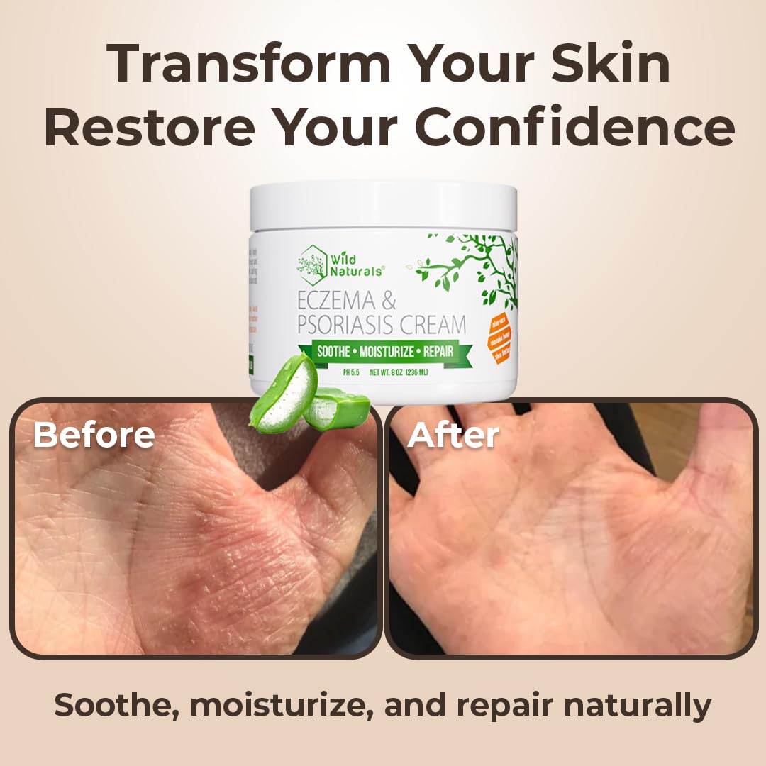 Wild Naturals Eczema & Psoriasis Cream for Dry, Itchy Skin – Eczema Relief