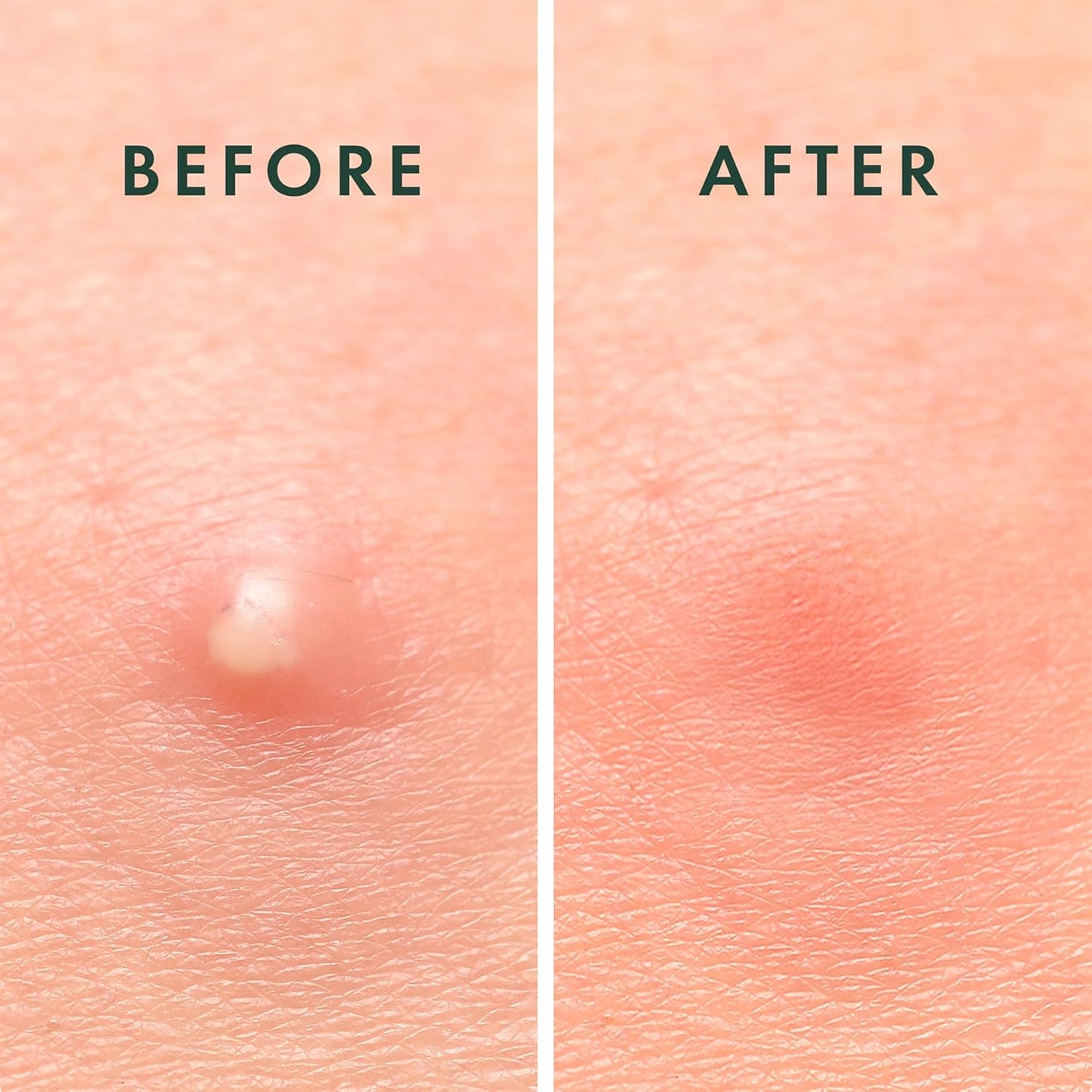 Rael Pimple Patches, Miracle Invisible Spot Cover - Hydrocolloid Acne Pimple Patch, Absorbs Zits & Blemish..